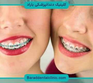 قیمت سیم کشی دندان در تهران