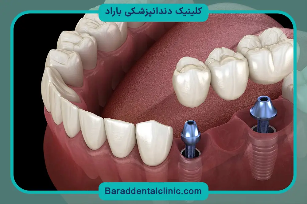 مراقبت‌های بعد از ایمپلنت تک دندان 