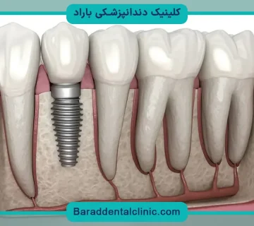 ایمپلنت جدید دندان