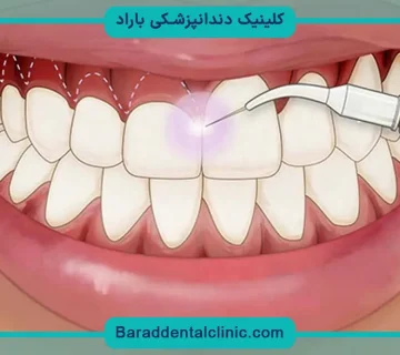 جراحی لثه برای ایمپلنت