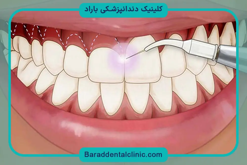 جراحی لثه برای ایمپلنت