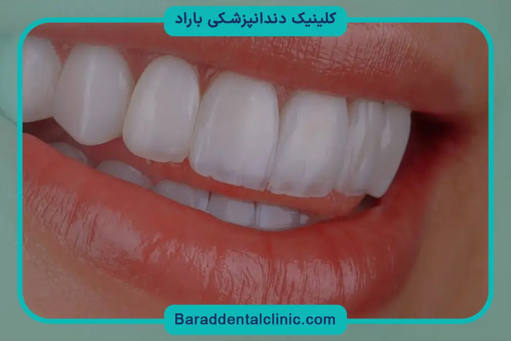قیمت کامپوزیت