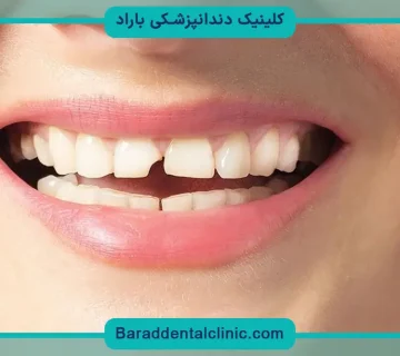 بازسازی دندان شکسته با پین