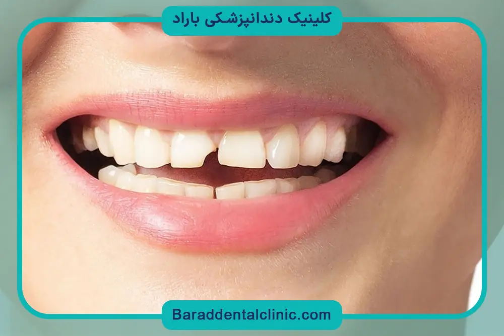 بازسازی دندان شکسته با پین