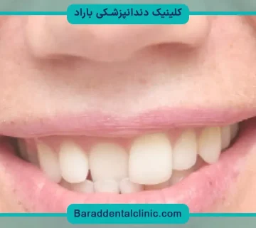 قیمت کامپوزیت دندان جلو