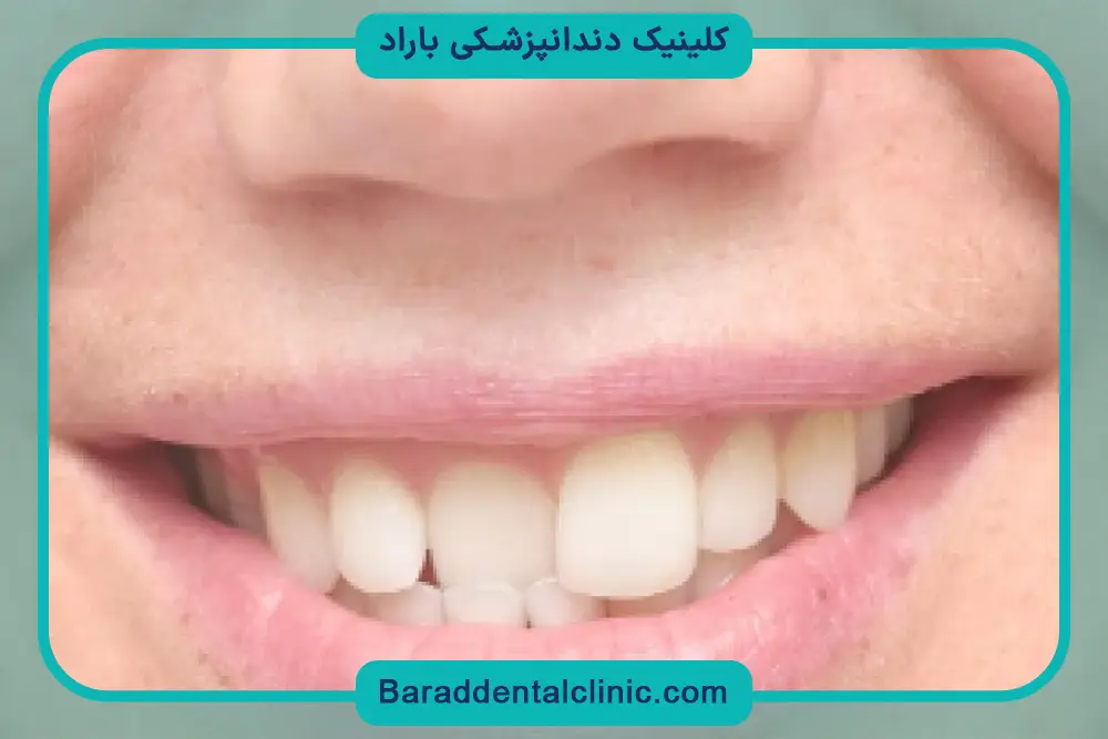 قیمت کامپوزیت دندان جلو