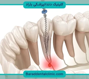 بازسازی دندان اندو شده