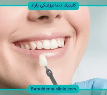 قیمت کامپوزیت فک بالا