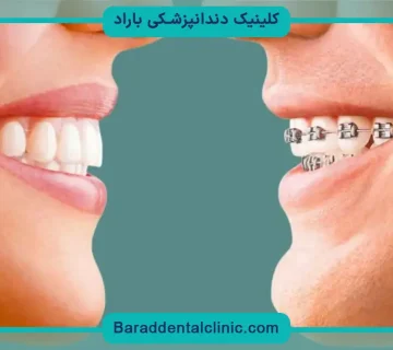 سیم کشی دندان خرگوشی
