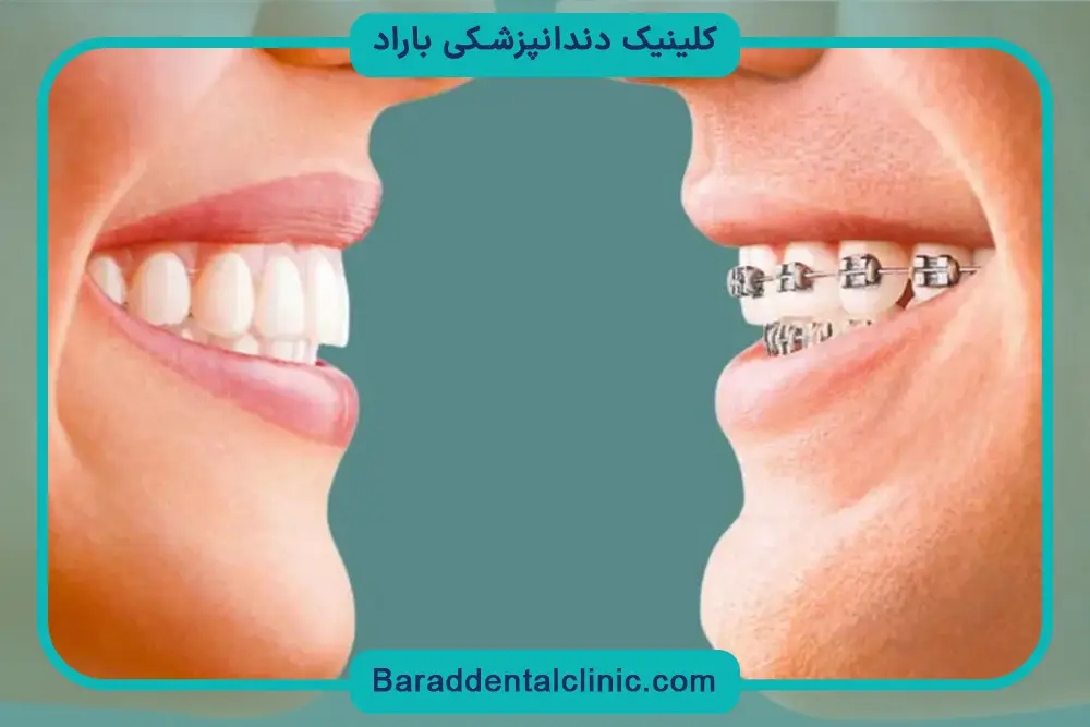 سیم کشی دندان خرگوشی