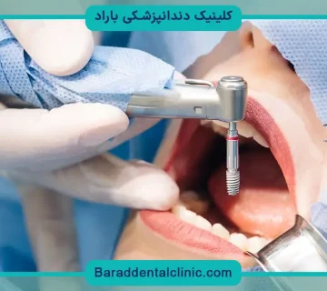قیمت ایمپلنت دندان در تهران