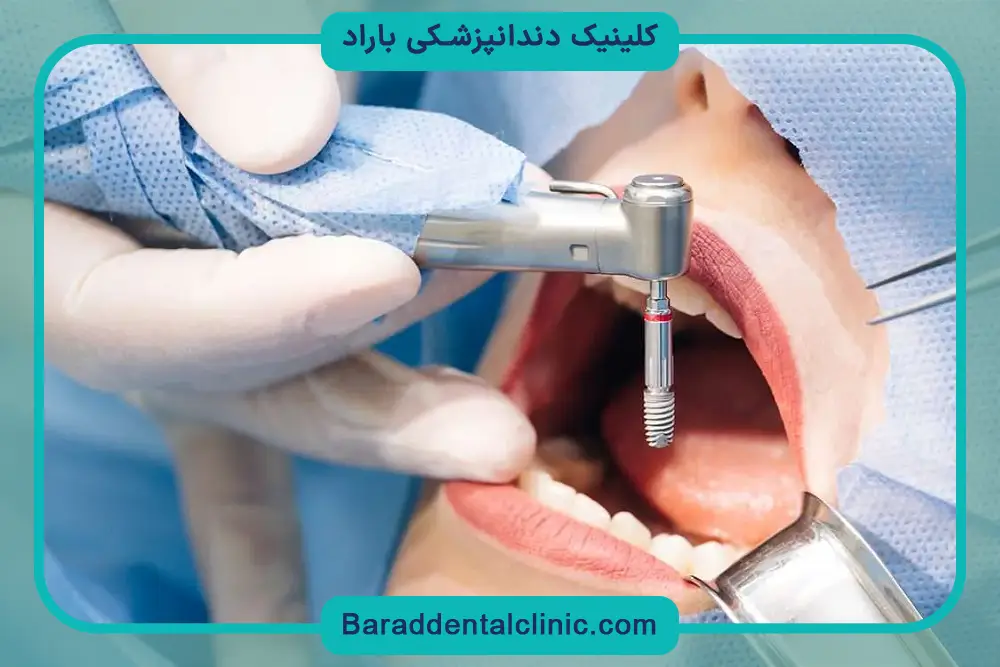 قیمت ایمپلنت دندان در تهران