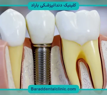 قیمت ایمپلنت یک دندان