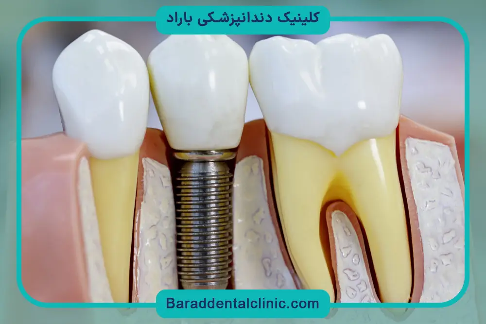 قیمت ایمپلنت یک دندان