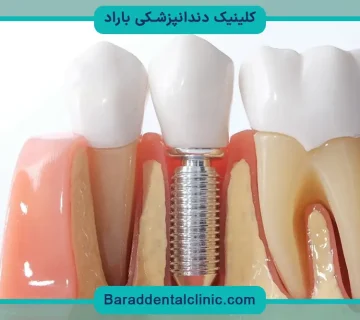 قیمت ایمپلنت آمریکایی