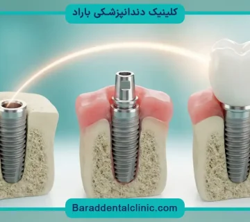 ایمپلنت ثابت فک بالا