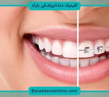 سیم کشی دندان چیست؟