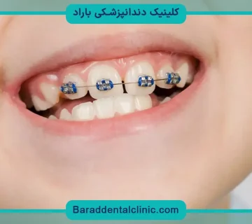 سیم کشی دندان چند ماه طول میکشد؟