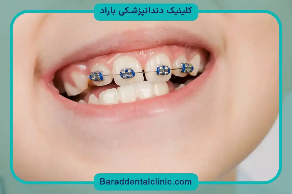 سیم کشی دندان چند ماه طول میکشد؟