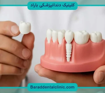 ایمپلنت ارزان دندان