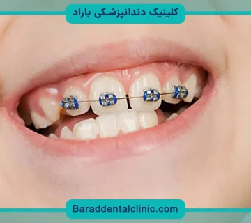 سیم کشی دندان در چه سنی مناسب است؟