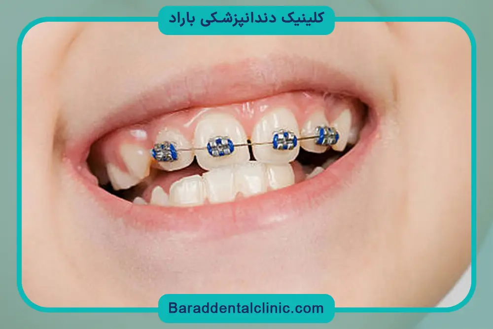 سیم کشی دندان در چه سنی مناسب است؟
