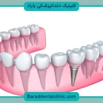 ایمپلنت کره ای