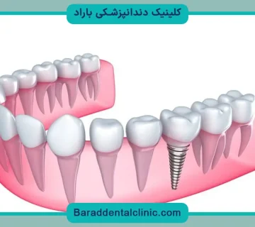 ایمپلنت کره ای