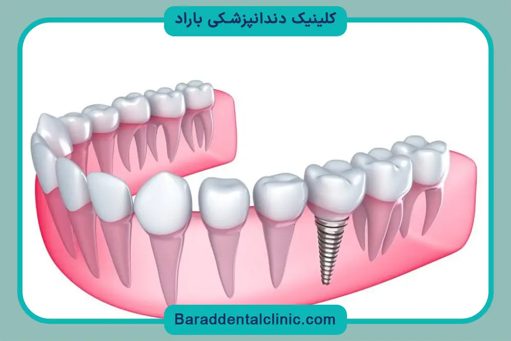ایمپلنت کره ای