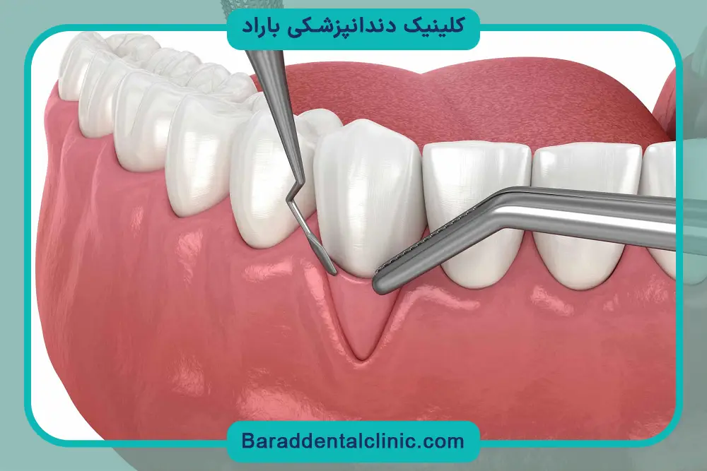 زمان نیاز به جراحی لثه برای ایمپلنت