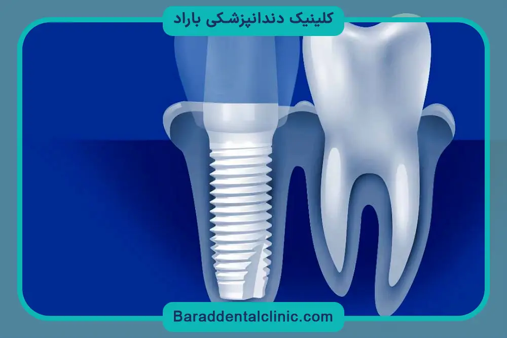 بررسی ایمپلنت بدون جراحی 