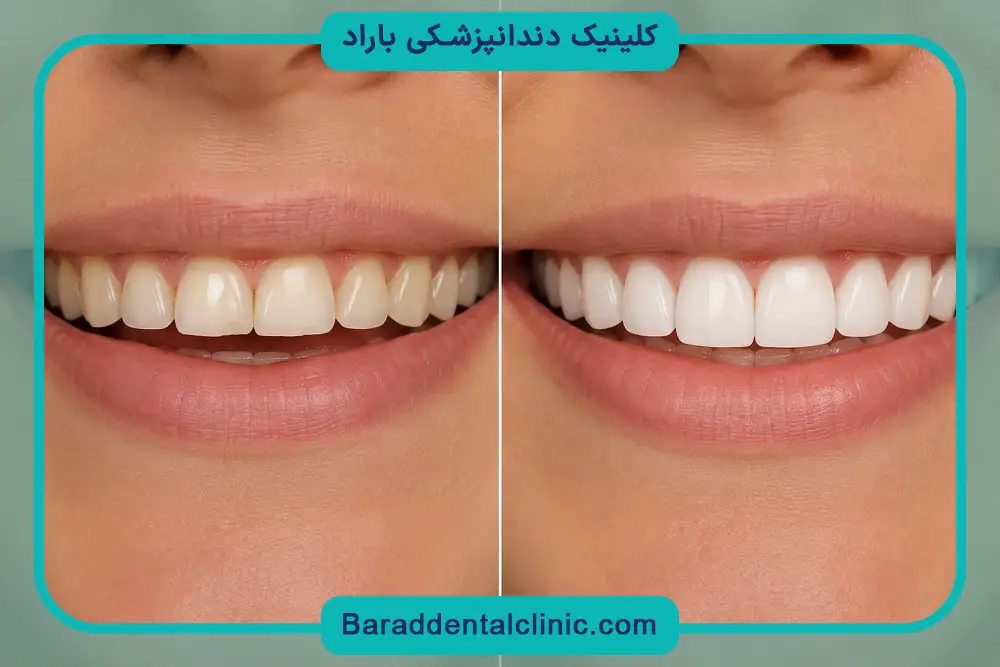 بررسی قیمت کامپوزیت کل دندان ها 