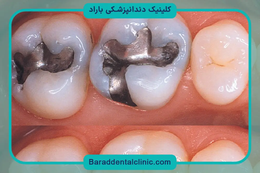 زمان نیاز به بازسازی دندان شکسته با پین 