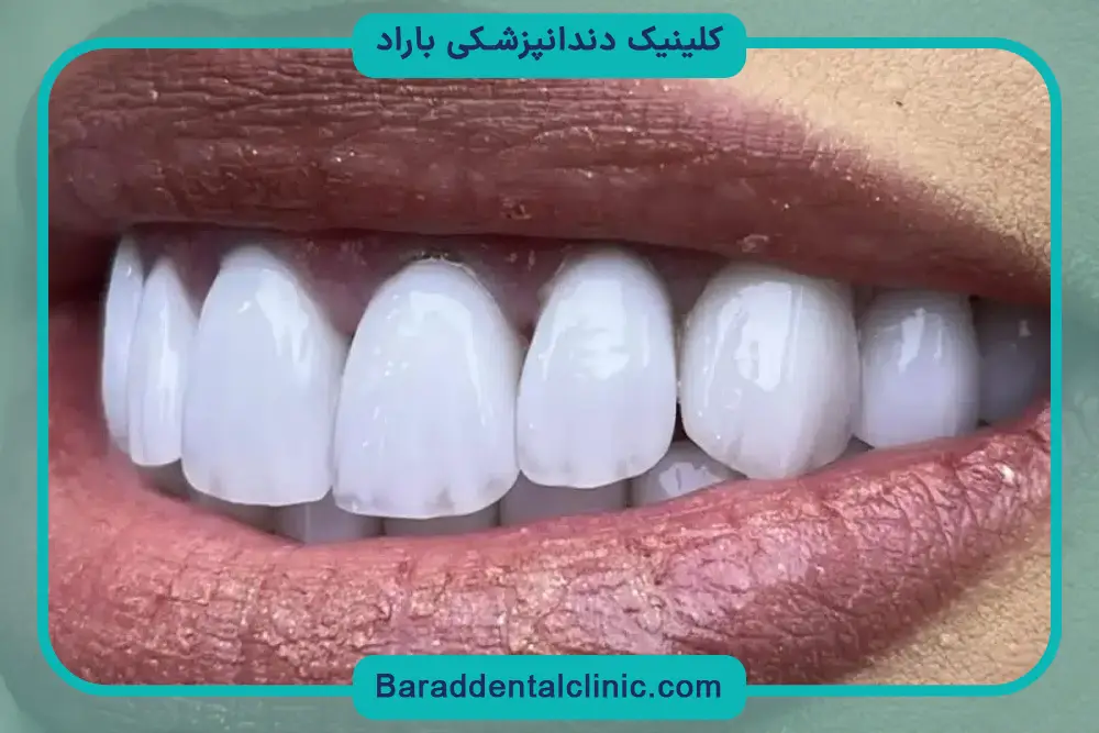 بررسی قیمت کامپوزیت دندان جلو