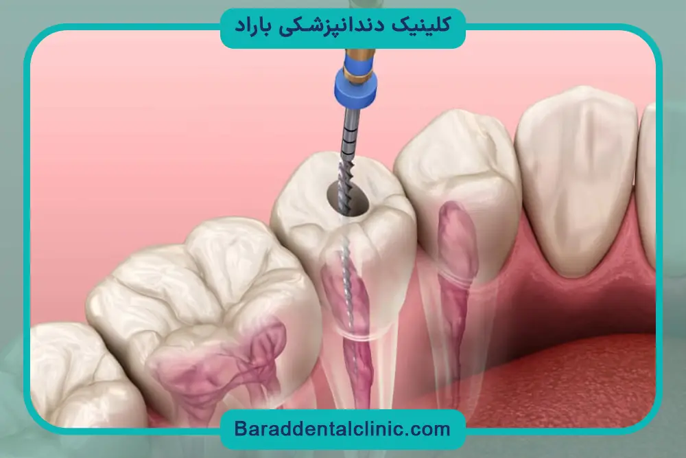 اهمیت بازسازی دندان اندو شده 