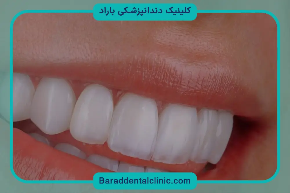 قیمت کامپوزیت فک بالا 6 دندان