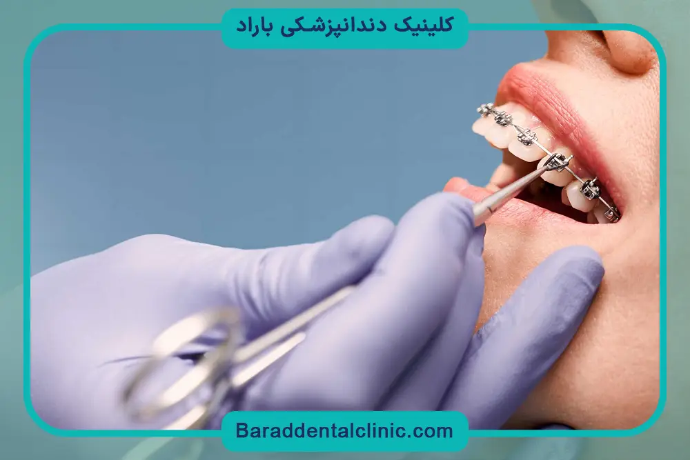 بررسی قیمت حدودی سیم کشی دندان 