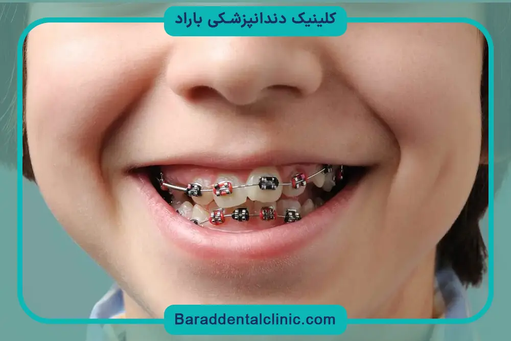 آشنایی با سیم کشی دندان خرگوشی 