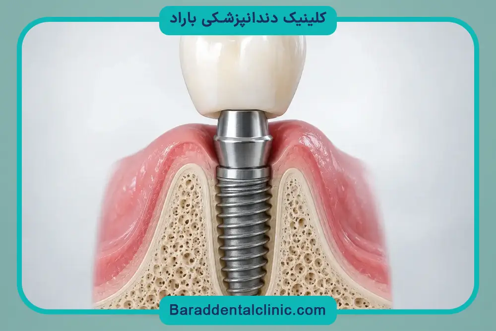 بررسی قیمت ایمپلنت فوری 