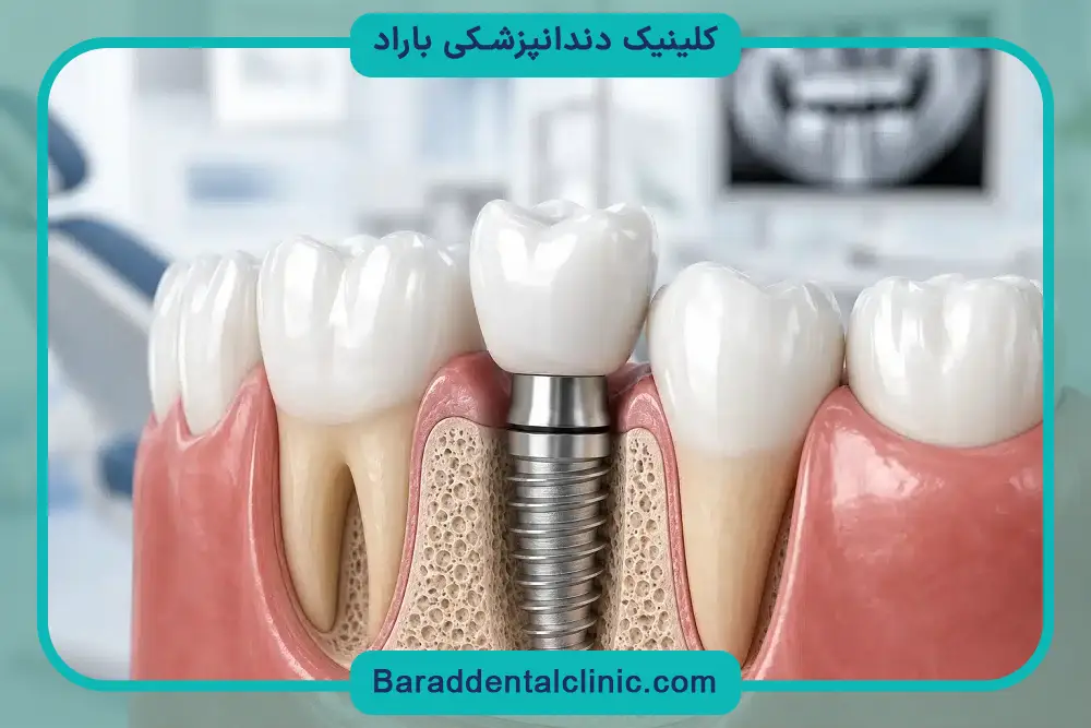 بررسی قیمت ایمپلنت یک دندان