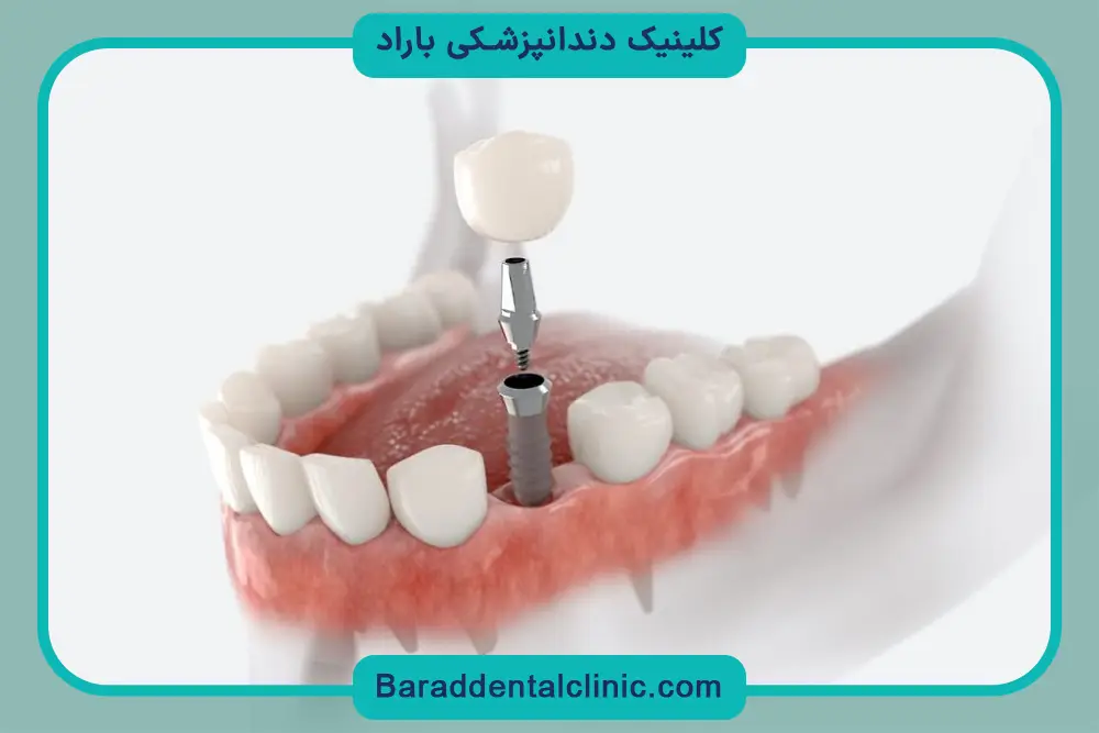 ایمپلنت دیجیتال دندان چیست؟