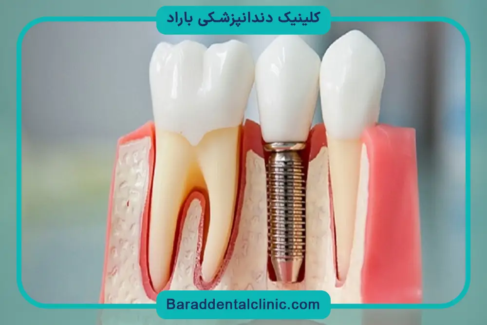 استانداردهای کیفی ایمپلنت کره ای