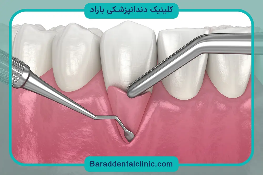 رابطه جراحی لثه برای ایمپلنت با پیوند استخوان