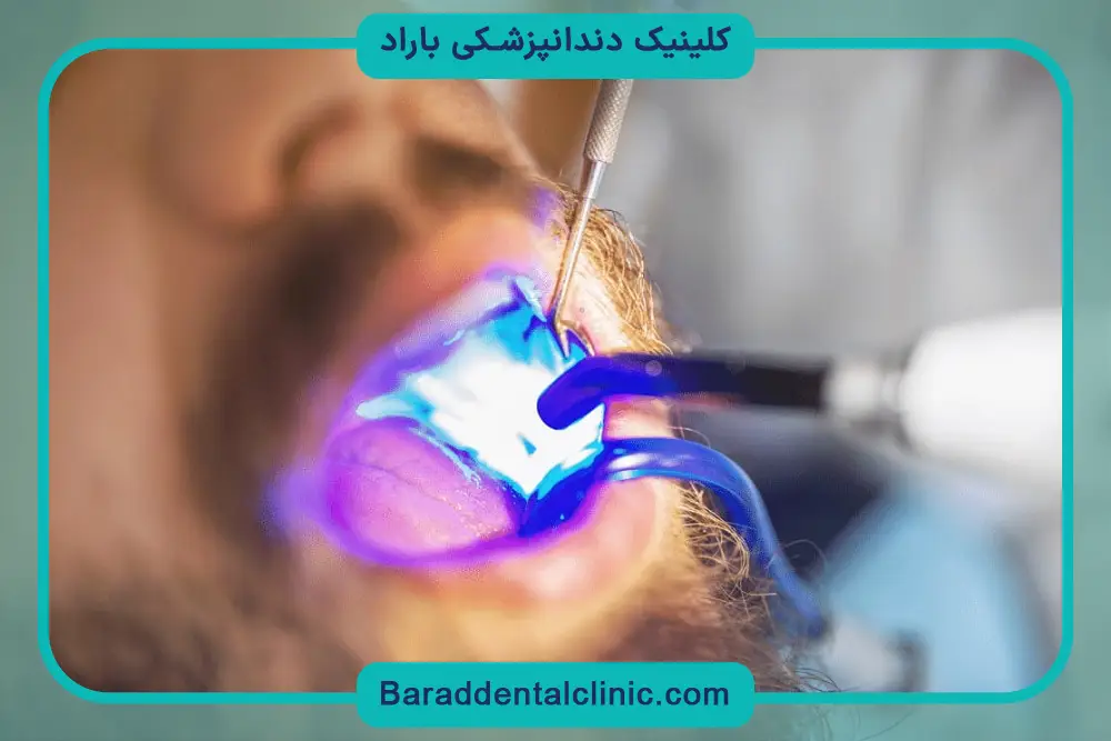 تاثیر تخصص دندانپزشک روی قیمت کامپوزیت