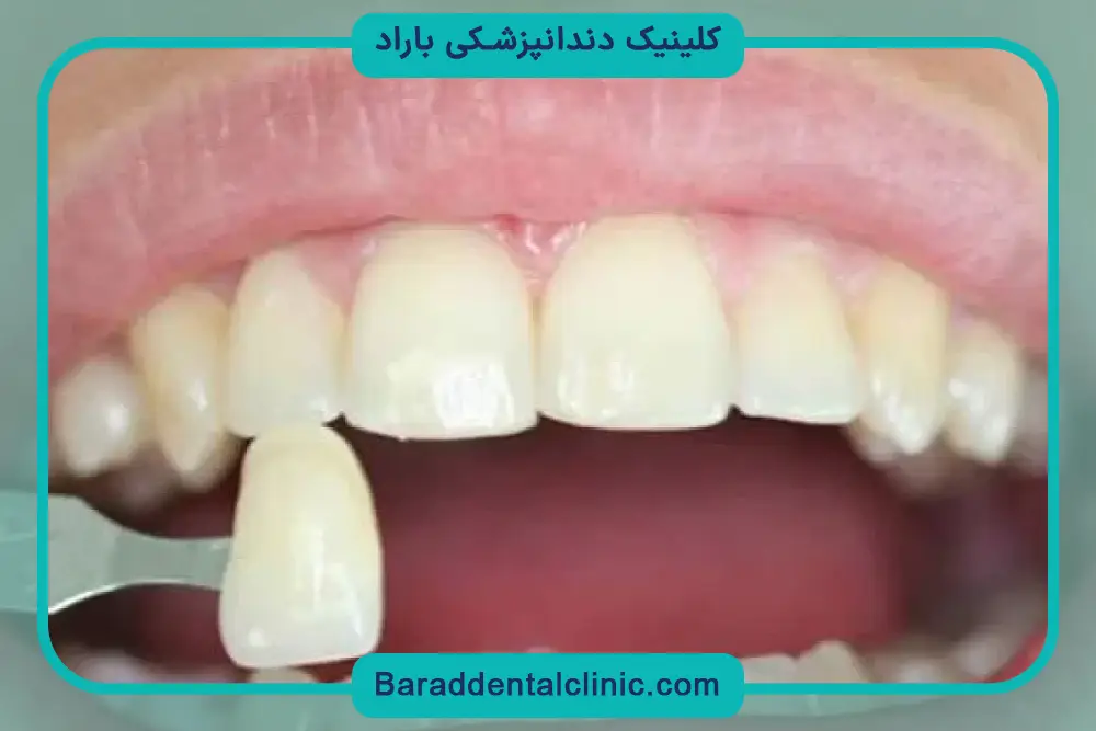 قیمت کامپوزیت فک بالا برای 10 الی 12 دندان