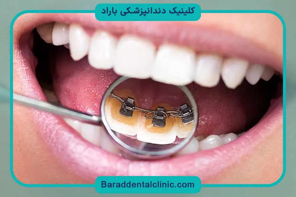 قیمت حدودی انواع سیم کشی دندان 