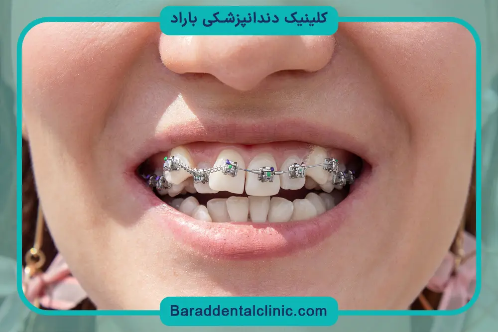 ابزارهای سیم کشی دندان خرگوشی 