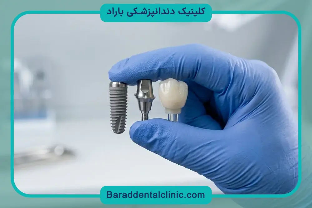 تاثیر درمان‌های جانبی روی قیمت ایمپلنت دندان در تهران 