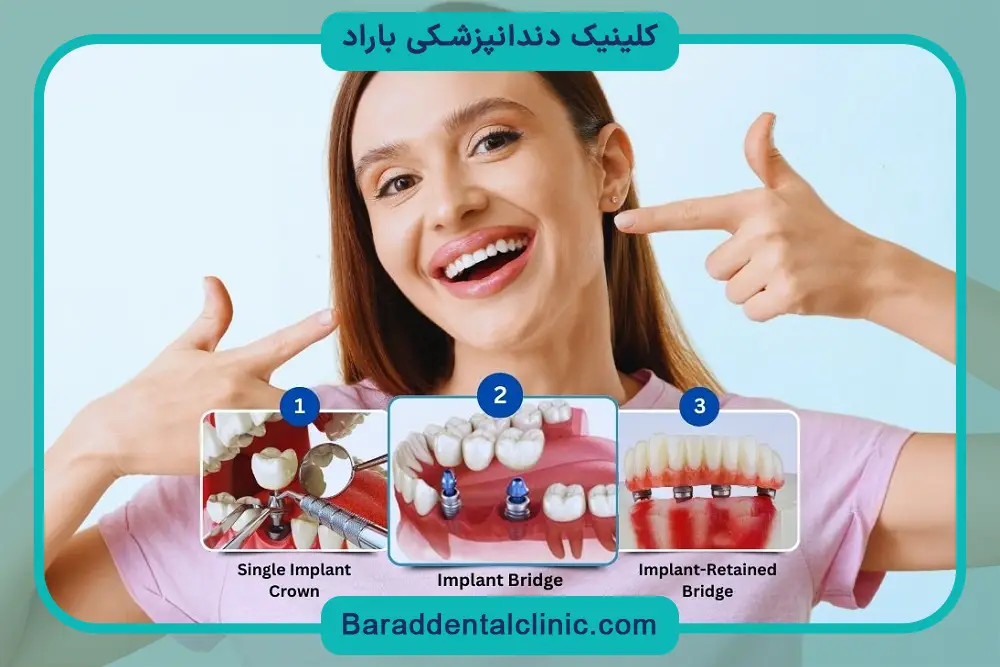 عوامل موثر بر قیمت ایمپلنت یک دندان