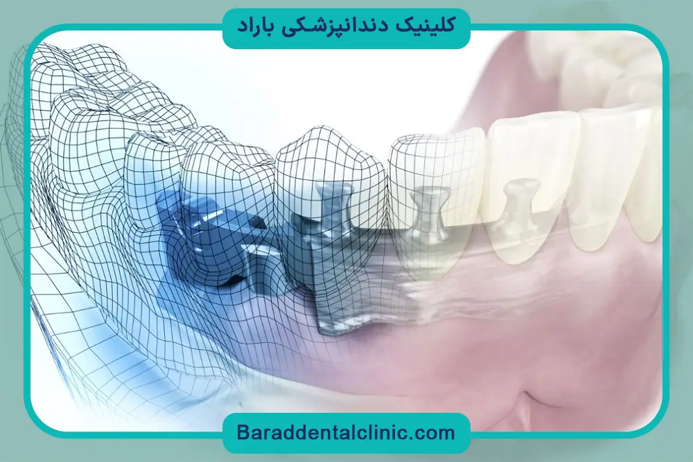 دقت  ایمپلنت دیجیتال دندان